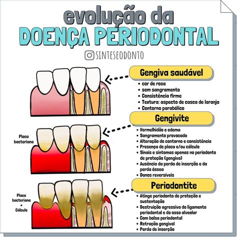 Ranhura vertical e horizontal dentistica